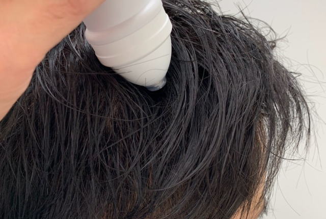 男性型脱毛症(AGA)治療方法